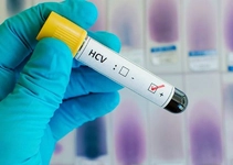 Kronik Hepatit C Belirtileri ve Tedavisi