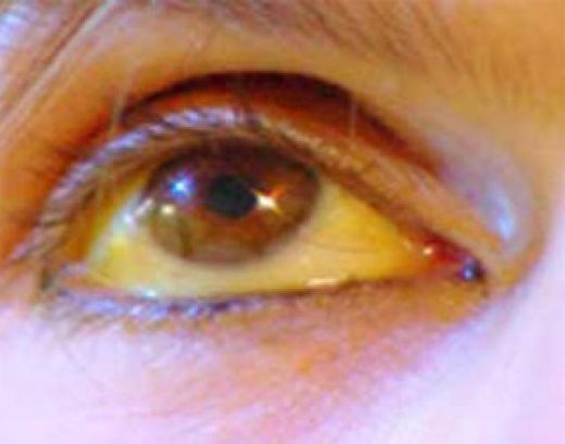 Sarılık Hepatit B Belirtileri ve Tedavisi